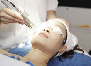 Thực hư về cách trị tàn nhang bằng công nghệ laser toning 